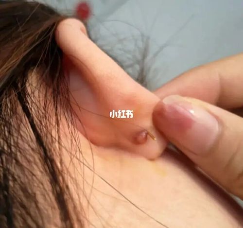 耳洞旁边长了一个血包怎么办