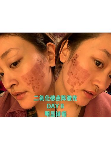 day891011二氧化碳点阵激光祛痘坑