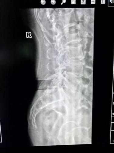 这是一张人体腰部x光片,今天去放射科送文件看到这个,我还以为下面