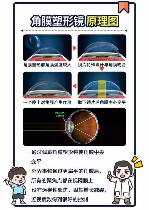 角膜塑形镜的原理?