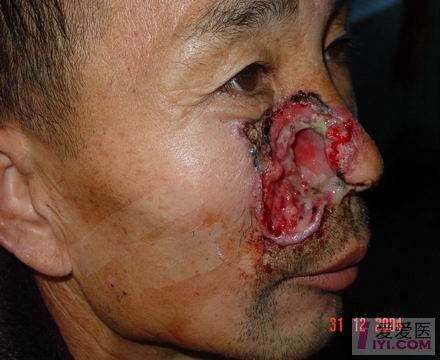 颊癌的罕见照片