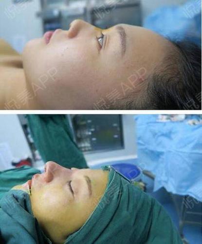 先去拍的x光片,要看看我的肋骨有没有钙化,钙化可能.