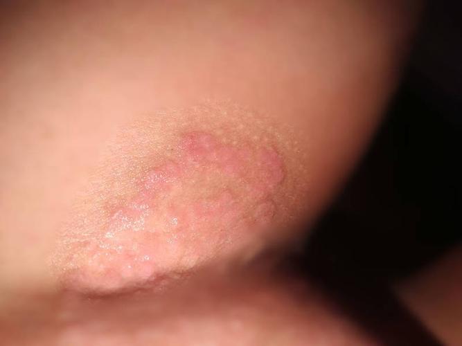 大腿内侧瘙痒,是不是股癣?医生:生活注意5点