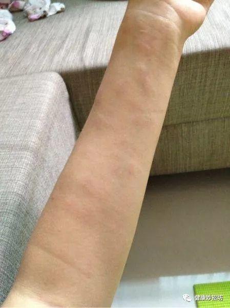 丘疹性荨麻疹症状5.胆碱能性荨麻疹.