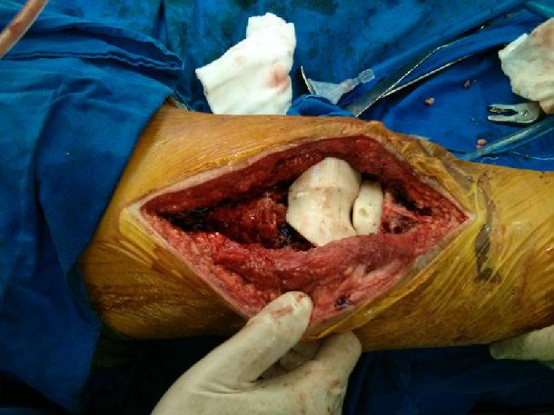 人工膝关节置换术后感染翻修