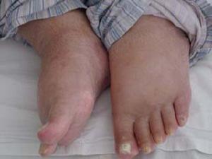 消耗性疾病长期营养缺乏,维生素b1缺乏症,粘液性水肿,药物性水肿等