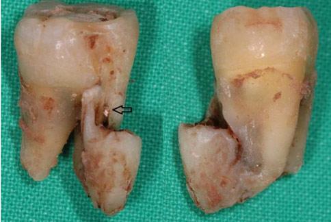 牙齿拔下来后,看到有两个牙根长在一起,竟是罕见「双生牙」.