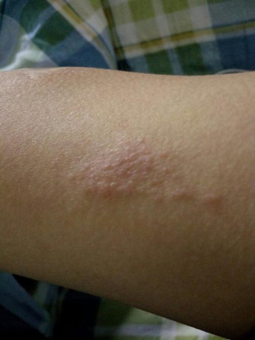 这是什么皮肤病,从今年起就一直没自动治愈好过(没去药房买过药,同学