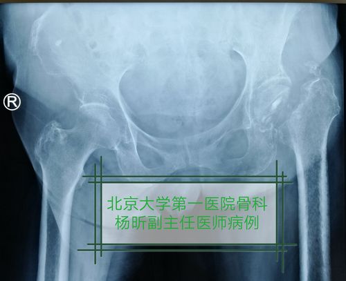 患者左侧股骨颈骨折保守治疗半年后,可见骨折断端骨吸收,局部骨质