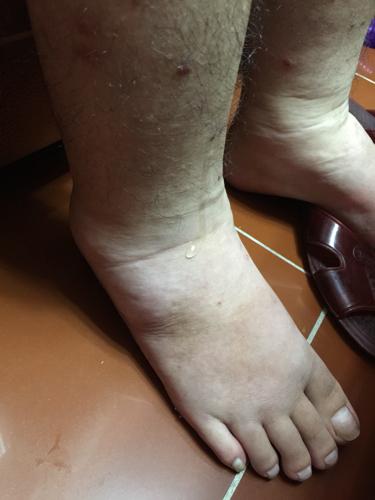 男孩18岁,患有慢性肾小球肾炎,脚都肿到冒水了,现在面部已经消肿,但脚