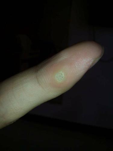 求有经验者回答.大蒜敷能去除疣子