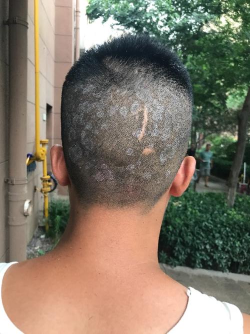 我这是不是头皮癣