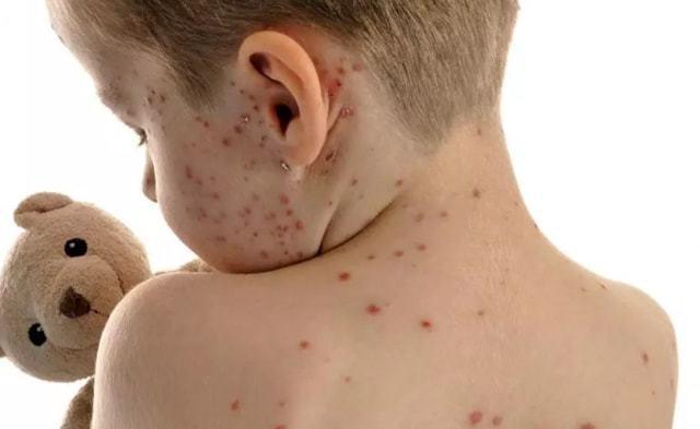 水痘是病毒感染导致痒感剧烈虽可自愈但不要抓挠