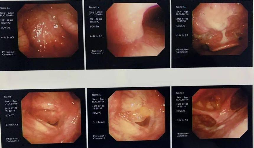 八旬大爷声音嘶哑二十余年未重视声带息肉堵满喉腔致呼吸困难