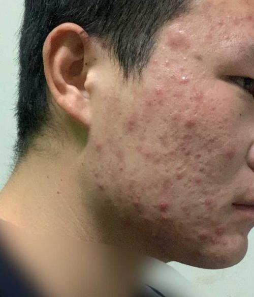 如何正确处理痘痘