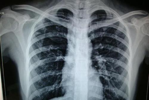 2个月前的胸片