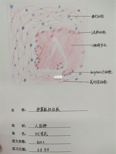 染成粉红色细颗粒状,干酪样坏死周围可见上皮样细胞,朗汉斯巨细胞,上