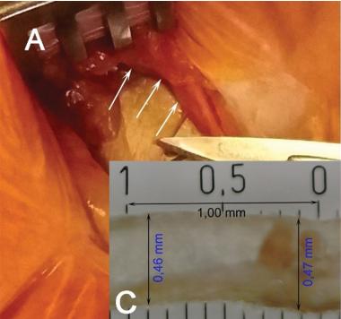 小医生带你探秘:起搏器囊袋长啥样?|温故知"心"