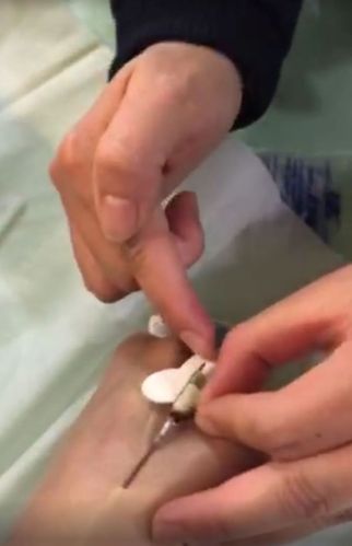 密闭式留置针穿刺注意点