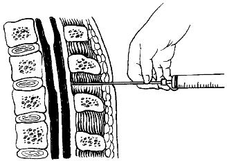 腰椎穿刺术_现代急诊急救护理