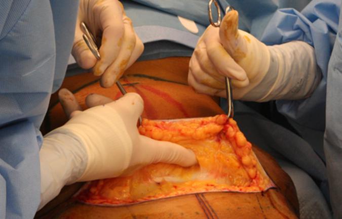 但,腹壁整形的整个过程,比剖宫产手术复杂多了.