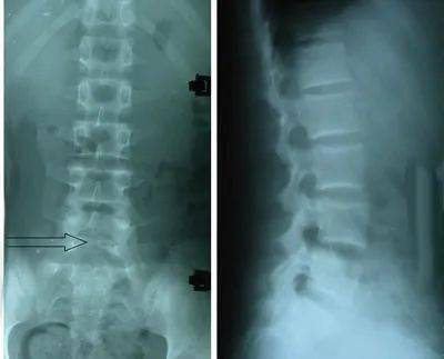隐性脊柱裂的人群发生率约在3/1000左右.