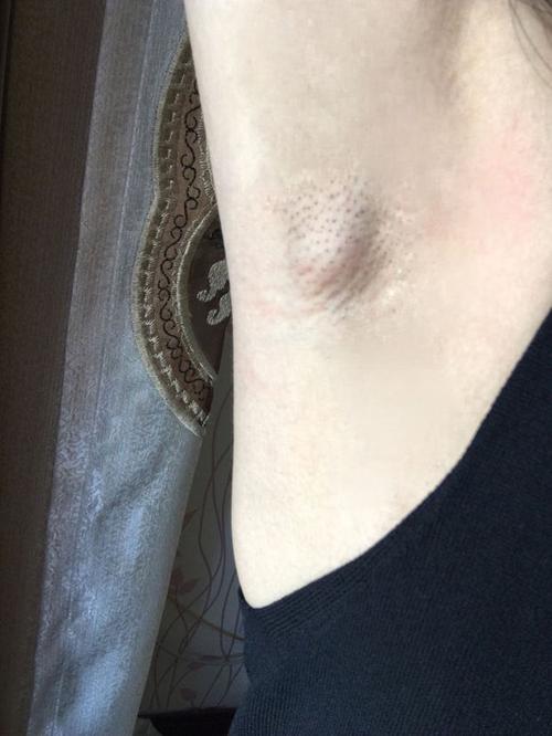 拔腋毛,腋窝皮里面起了一个大疙瘩,不按不疼