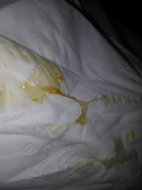 大便后纸上有这个血丝和这个白色粘液怎么了呢有没有医生帮我看下吗