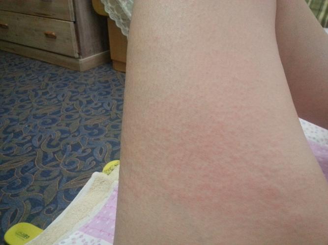 大腿皮下对称长了两片疙瘩,没有颜色,都苍起来了,(腿内侧没有