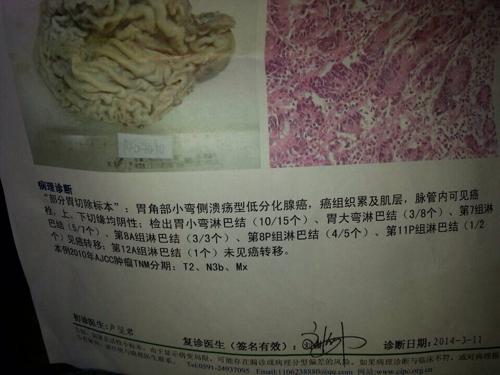 胃癌已做了手术了,要不要做化疗?做了化疗
