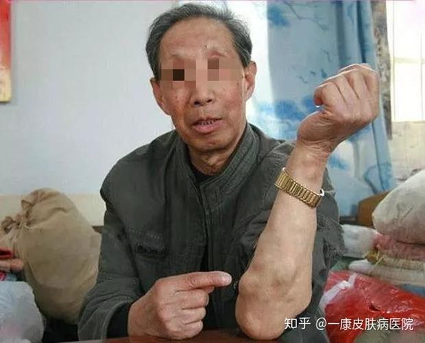 我院成功开展一例巨大脂肪瘤切除手术