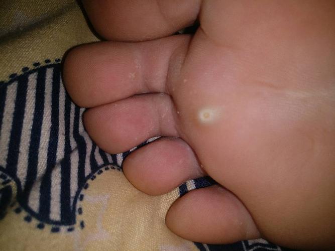 这是鸡眼还是趾疣,我该怎么治疗,中间有个坑