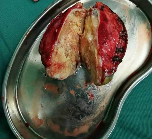 住院后完善手术前检查于1月28日行头皮肿物切除术,完整切除头皮肿物