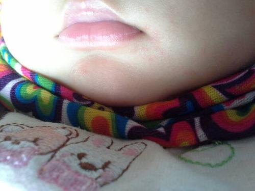 推荐回答 你好,这是湿疹,又称为奶癣,是吃奶的孩子一种特有的病