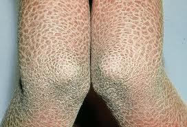 皮肤粗糙干燥 当心是鱼鳞病的症状