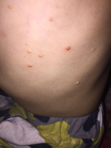 小孩身上长痘痘 怎么回事啊 有知道的吗