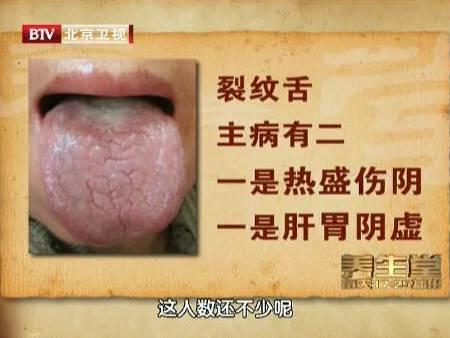 裂纹舌是怎么回事?