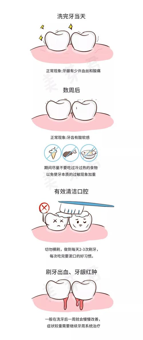 伢典科普洗牙全攻略——史上最全的洗牙介绍和问答集锦
