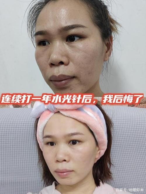 连续打一年水光针我后悔了