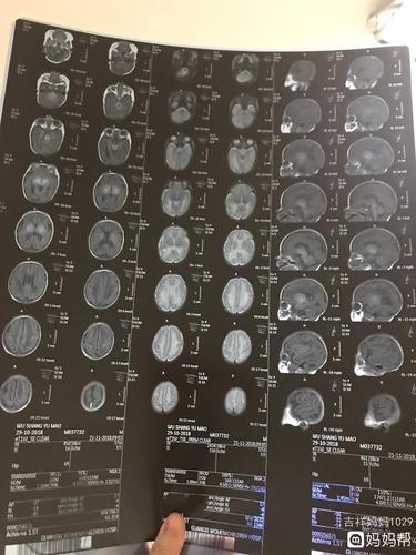 早产宝宝核磁共振检查结果,有脑白质软化,求正能量