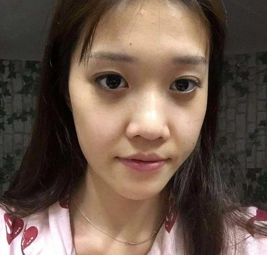 苹果肌下垂下颌缘臃肿脸看着超级大!为了拯救我的脸我终于决定做线雕.