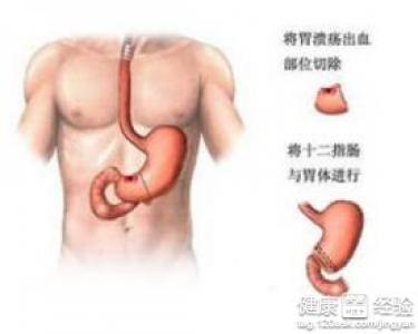 胃窦炎不能吃什么水果