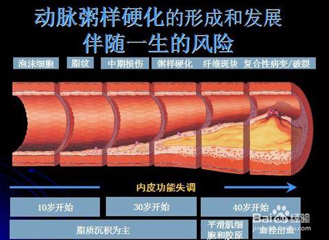 5  一:冠心病的发病机制:动脉粥样硬化的形成.
