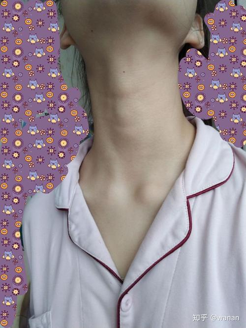 不请自来 作为一个从小喉结特别突出的女生,我很有发言权啊!