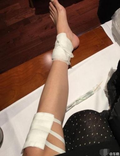 真人脚受伤包扎图片