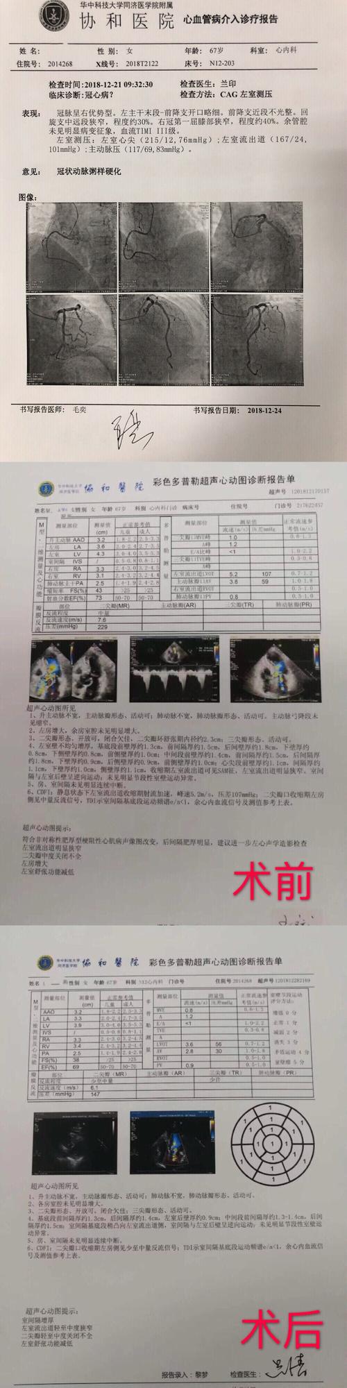 首例心腔内超声引导下肥厚型梗阻性心肌病射频消融术完成