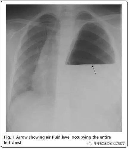 液气胸,很简单,我也是这么认为的. 那么,开始回首往事,以史