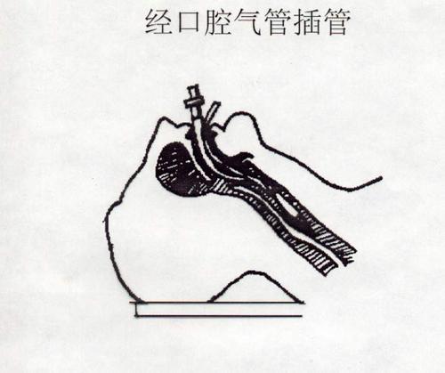 外科学图片集锦:经口腔气管插管
