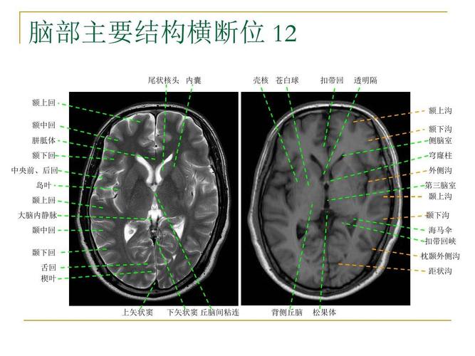 脑部主要结构mri横断位解剖