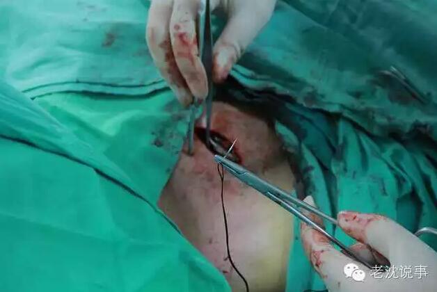 起搏器被放入心脏过程详解!